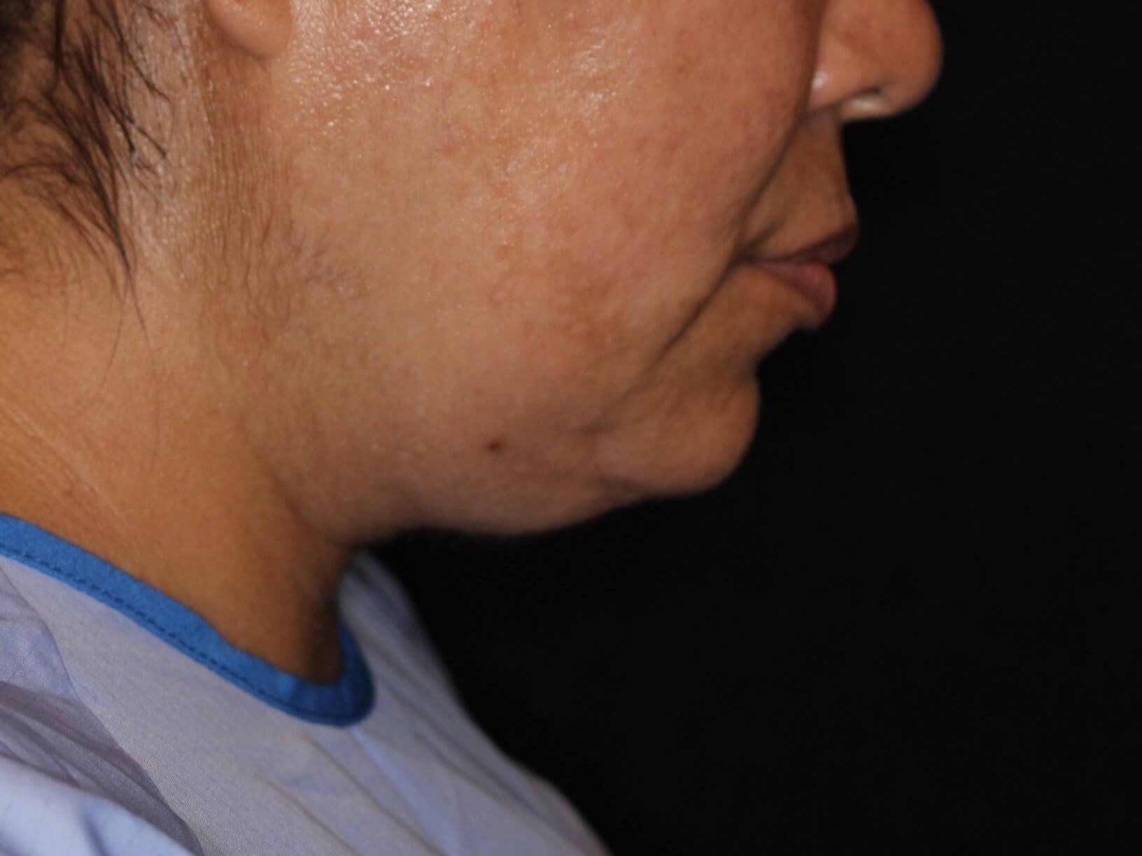 Double Chin Removal Before