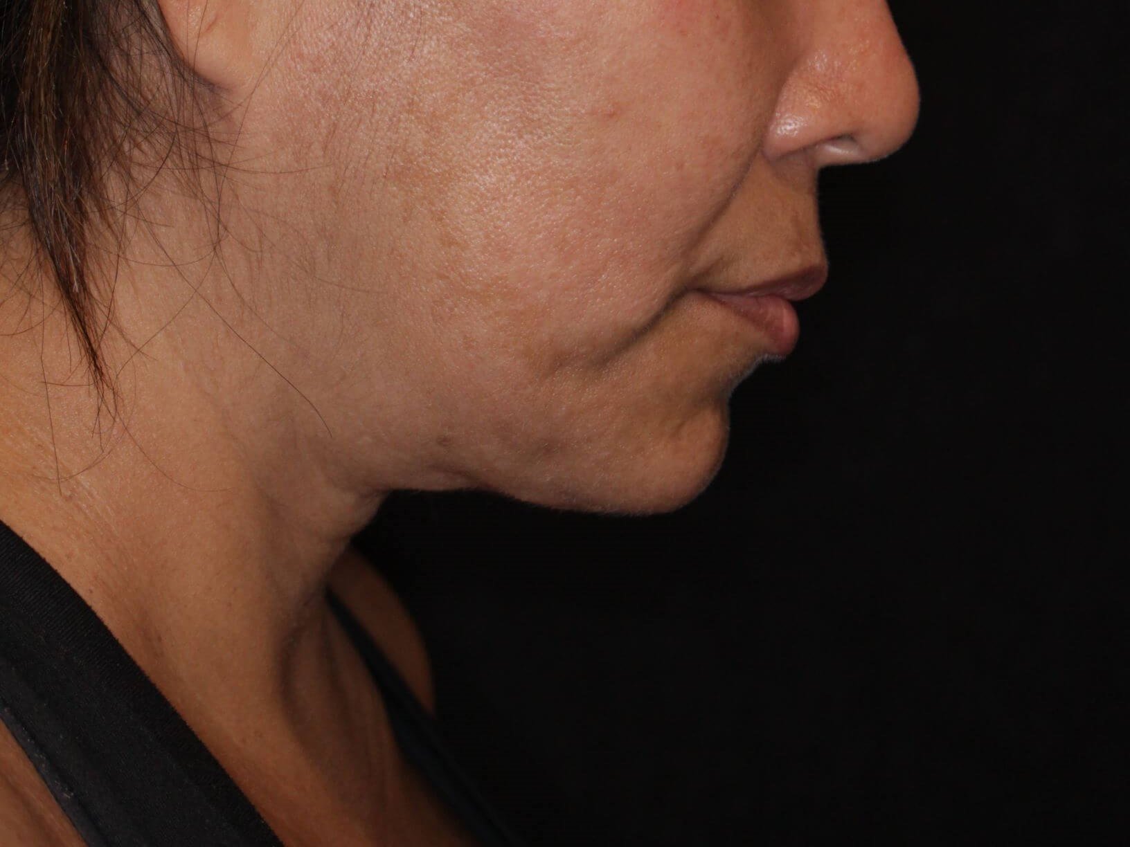 Double Chin Removal After