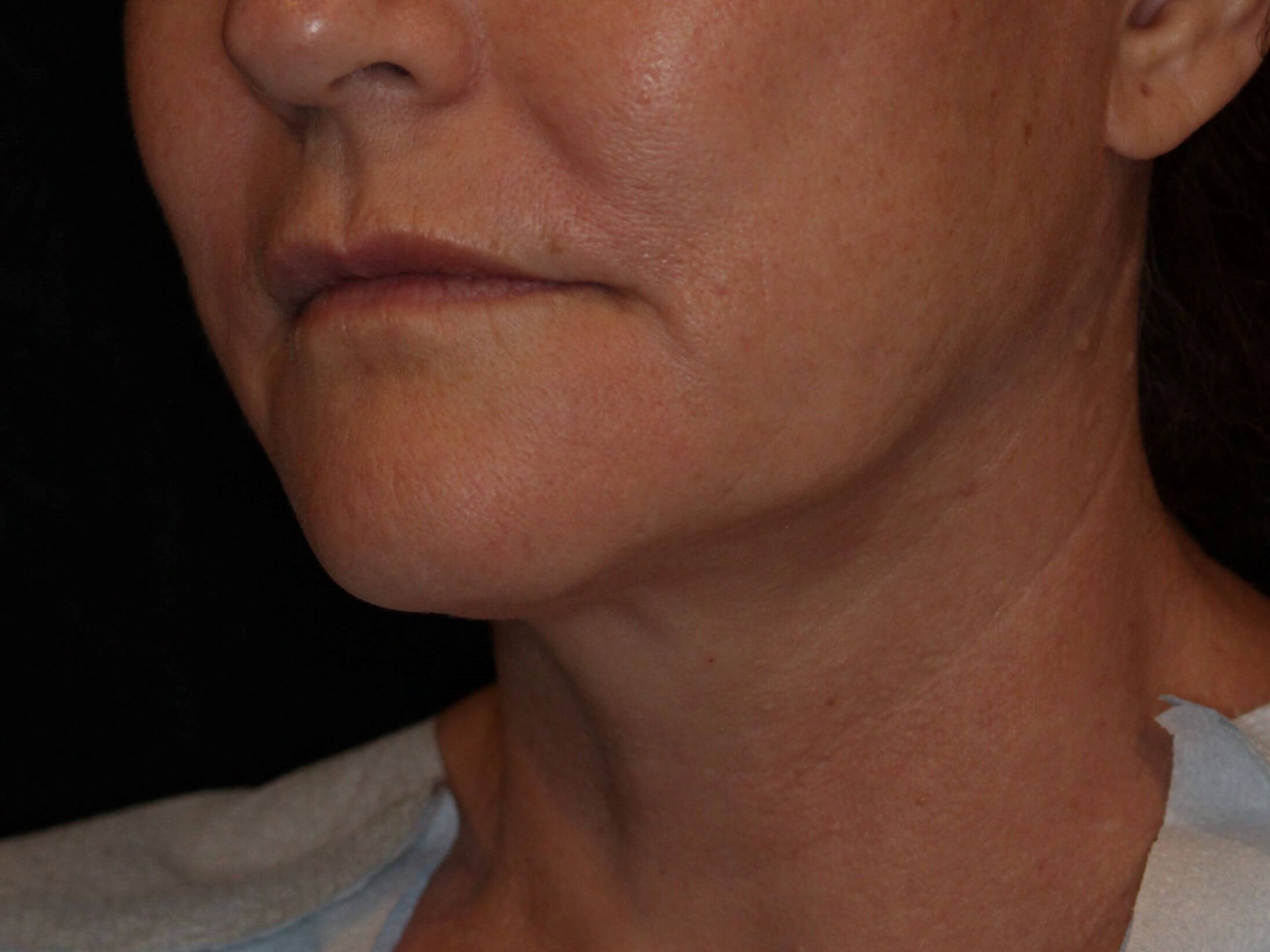 Double Chin Removal Before