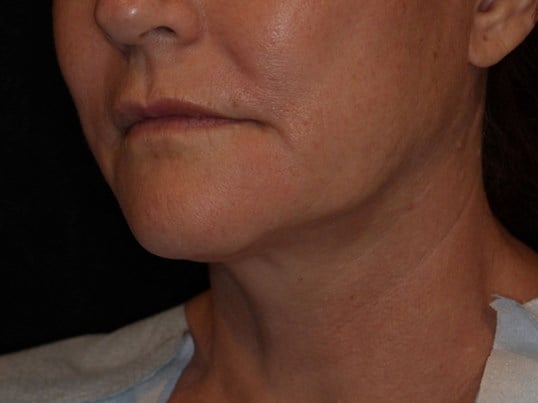 Double Chin Removal Before