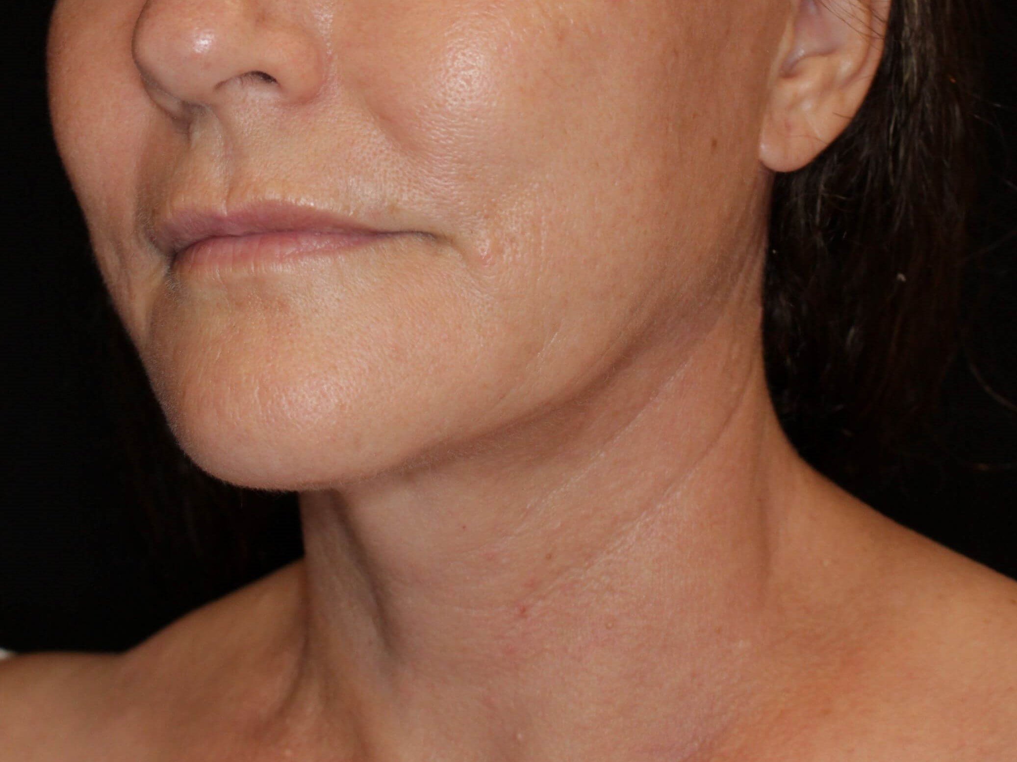 Double Chin Removal After