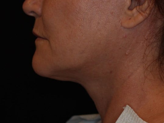 Double Chin Removal Before