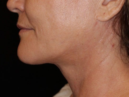 Double Chin Removal After