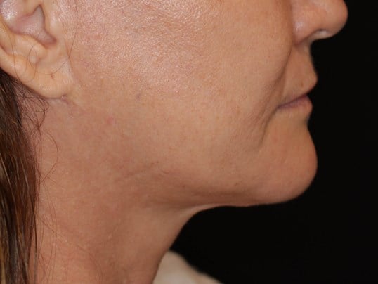 Double Chin Removal After