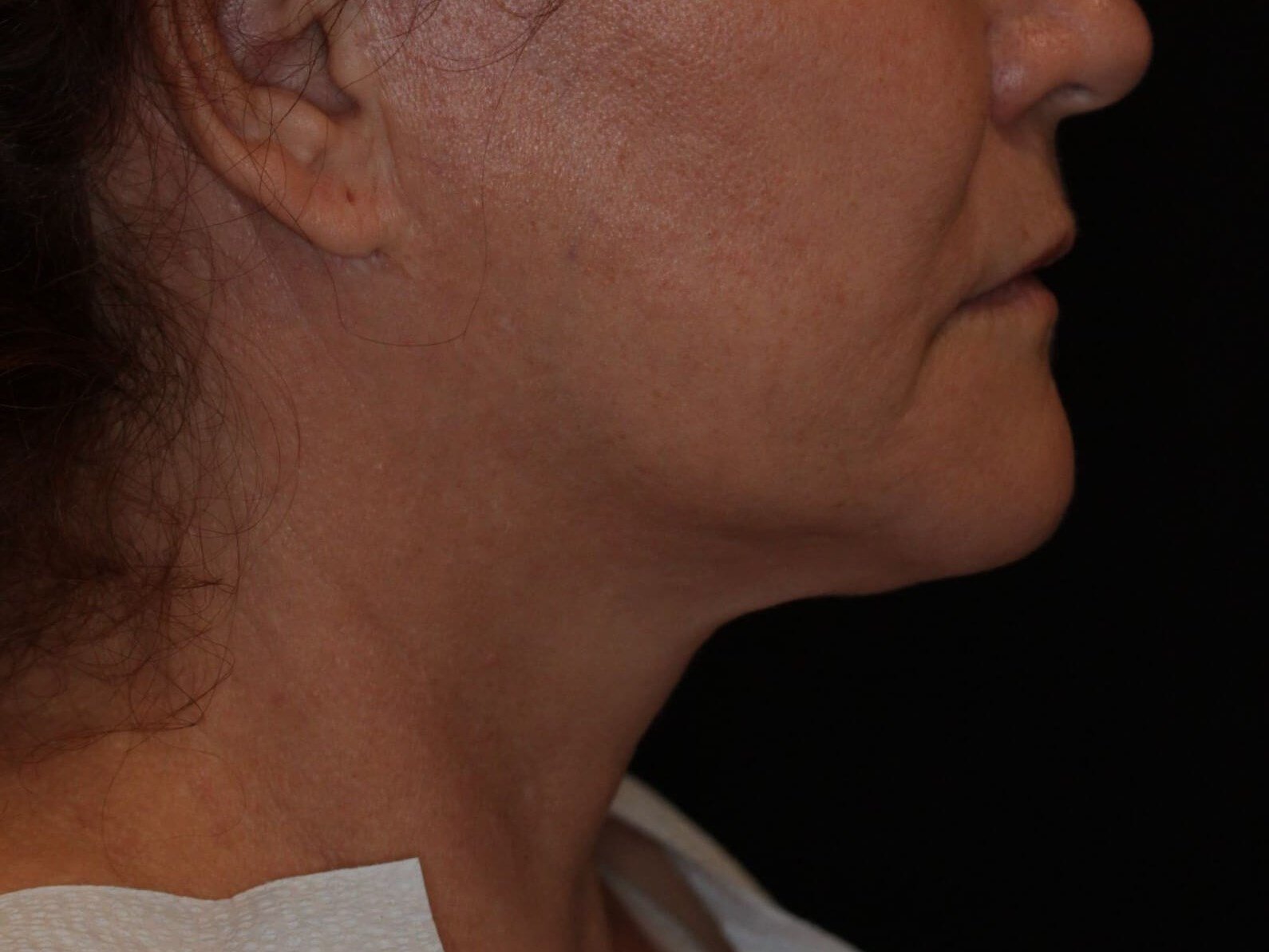 Double Chin Removal Before