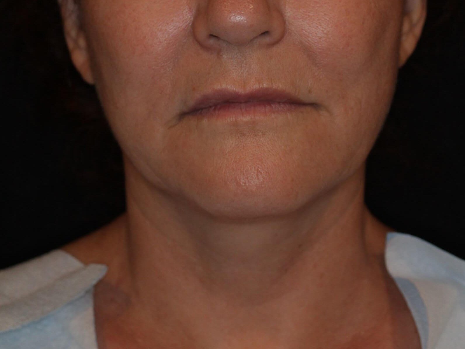 Double Chin Removal Before