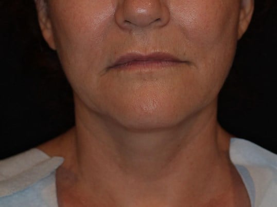 Double Chin Removal Before