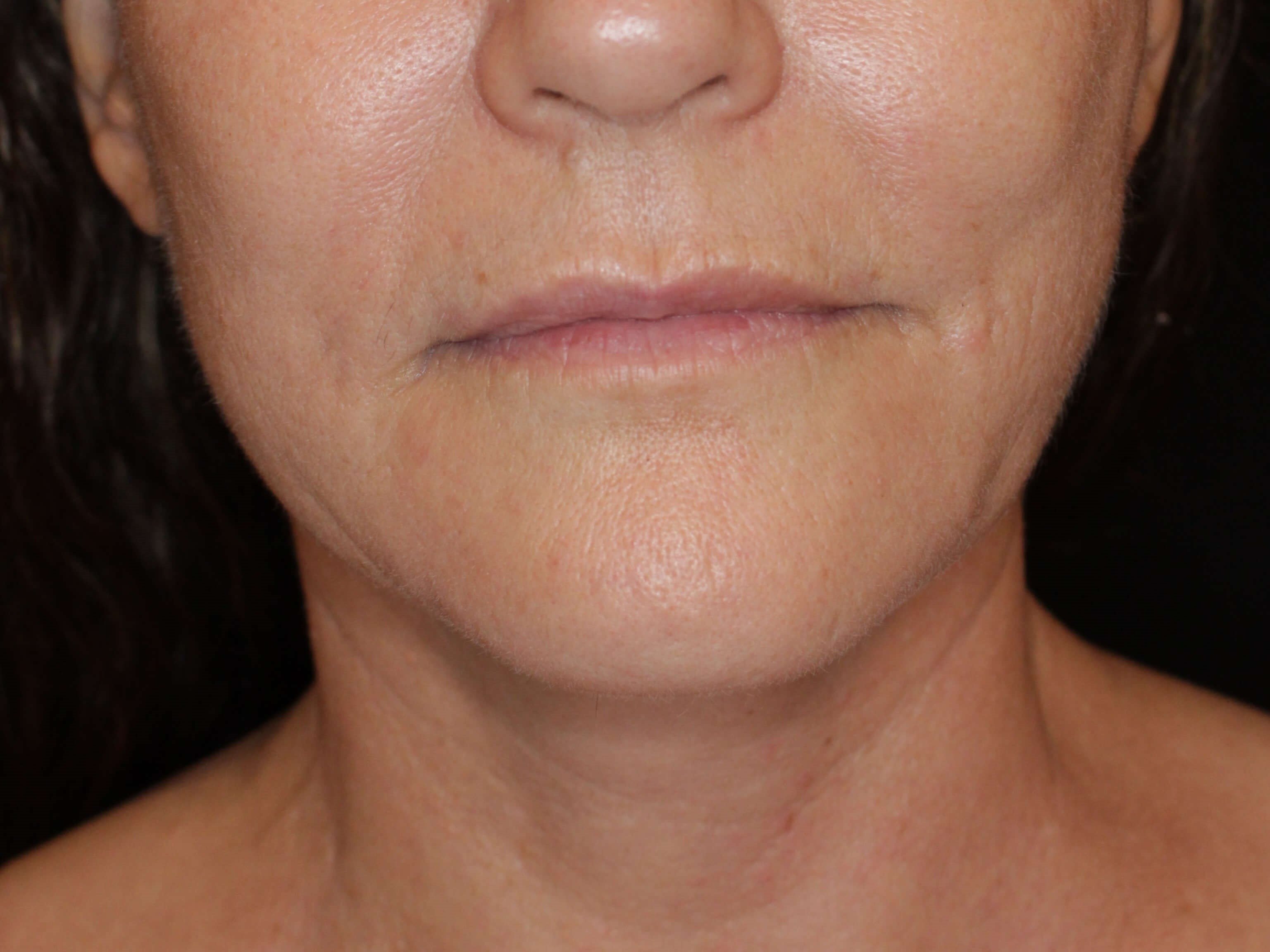 Double Chin Removal After