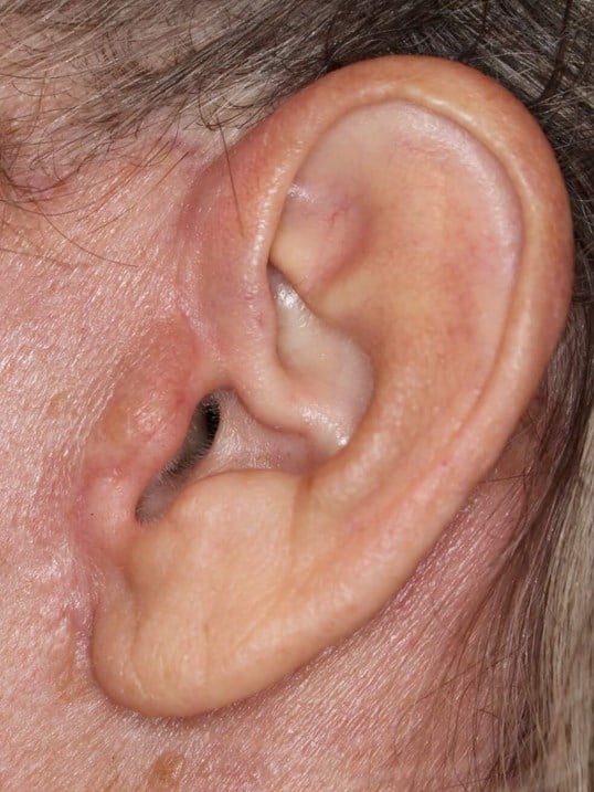 Face Lift Scar After