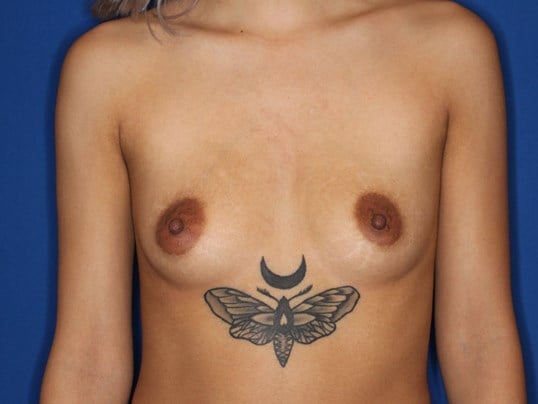 Silicone Implants 280 cc Before