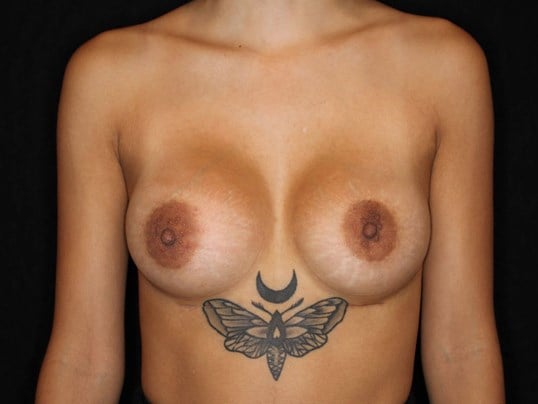 Silicone Implants 280 cc After