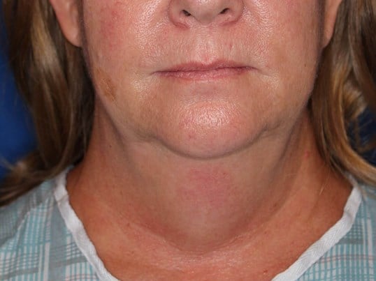 Double Chin Removal Before