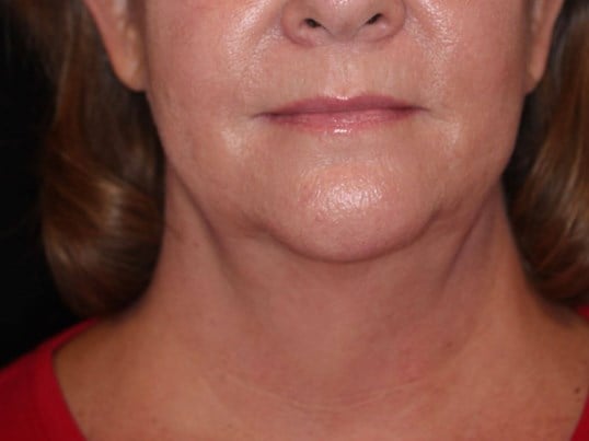 Double Chin Removal After
