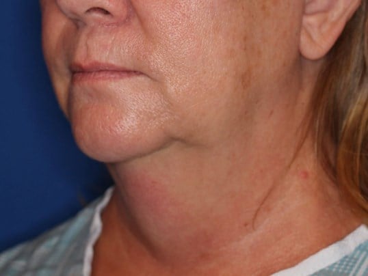 Double Chin Removal Before