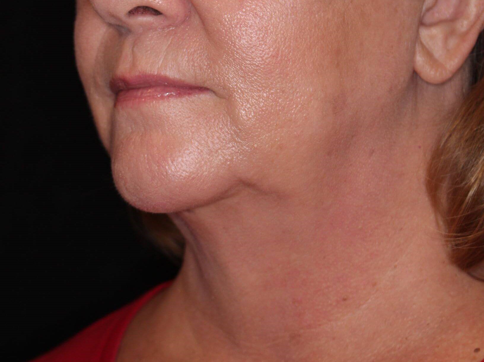 Double Chin Removal After