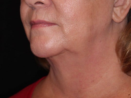 Double Chin Removal After