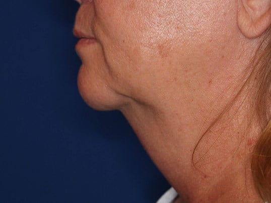 Double Chin Removal Before