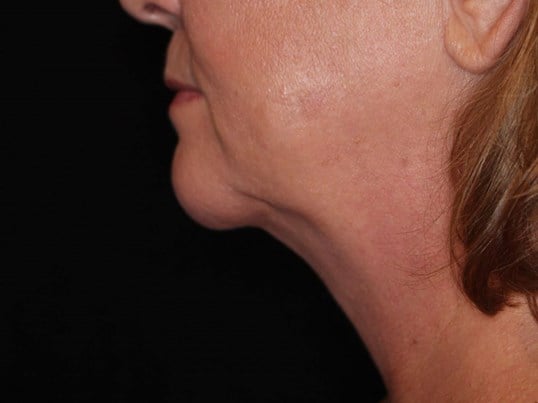 Double Chin Removal After