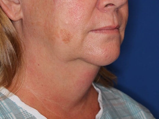 Double Chin Removal Before