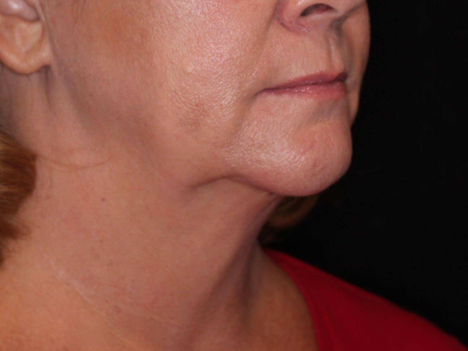 Double Chin Removal After