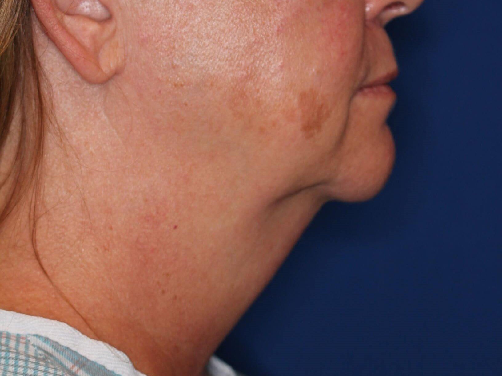 Double Chin Removal Before