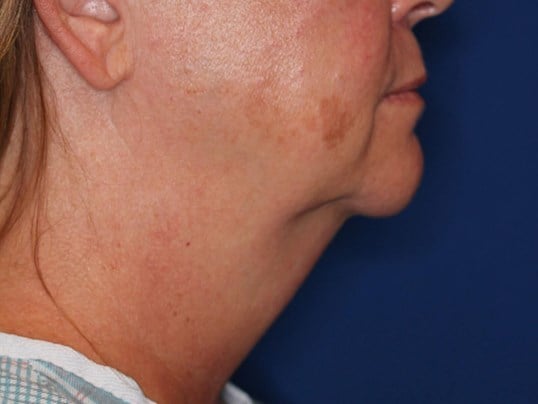 Double Chin Removal Before