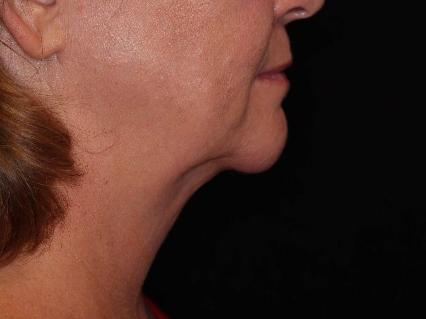 Double Chin Removal After