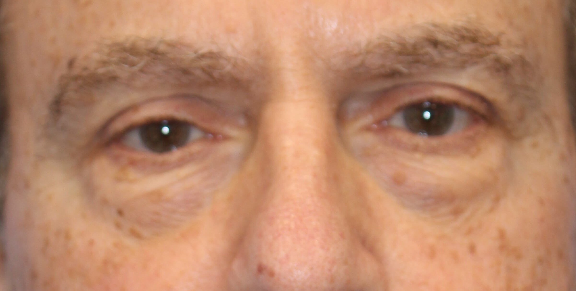 Lower Eyelid Lift Before