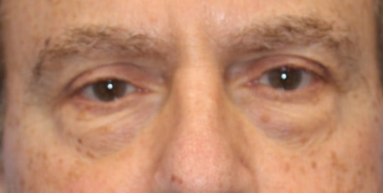 Lower Eyelid Lift Before