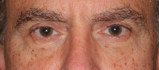 Lower Eyelid Lift After