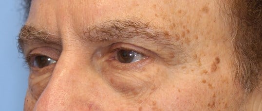 Lower Eyelid Lift Before