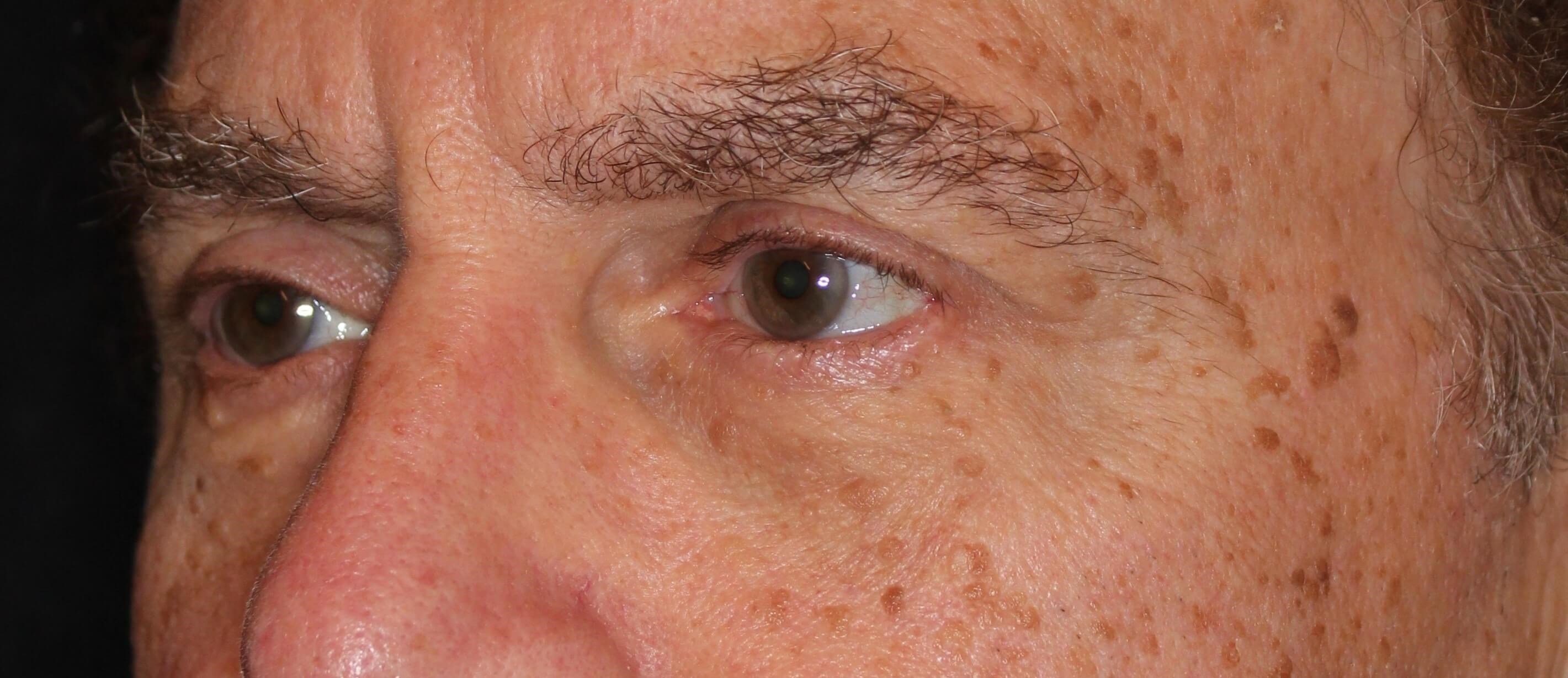 Lower Eyelid Lift After