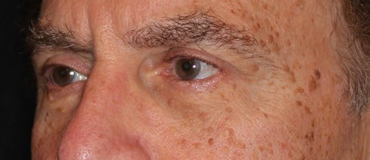 Lower Eyelid Lift After