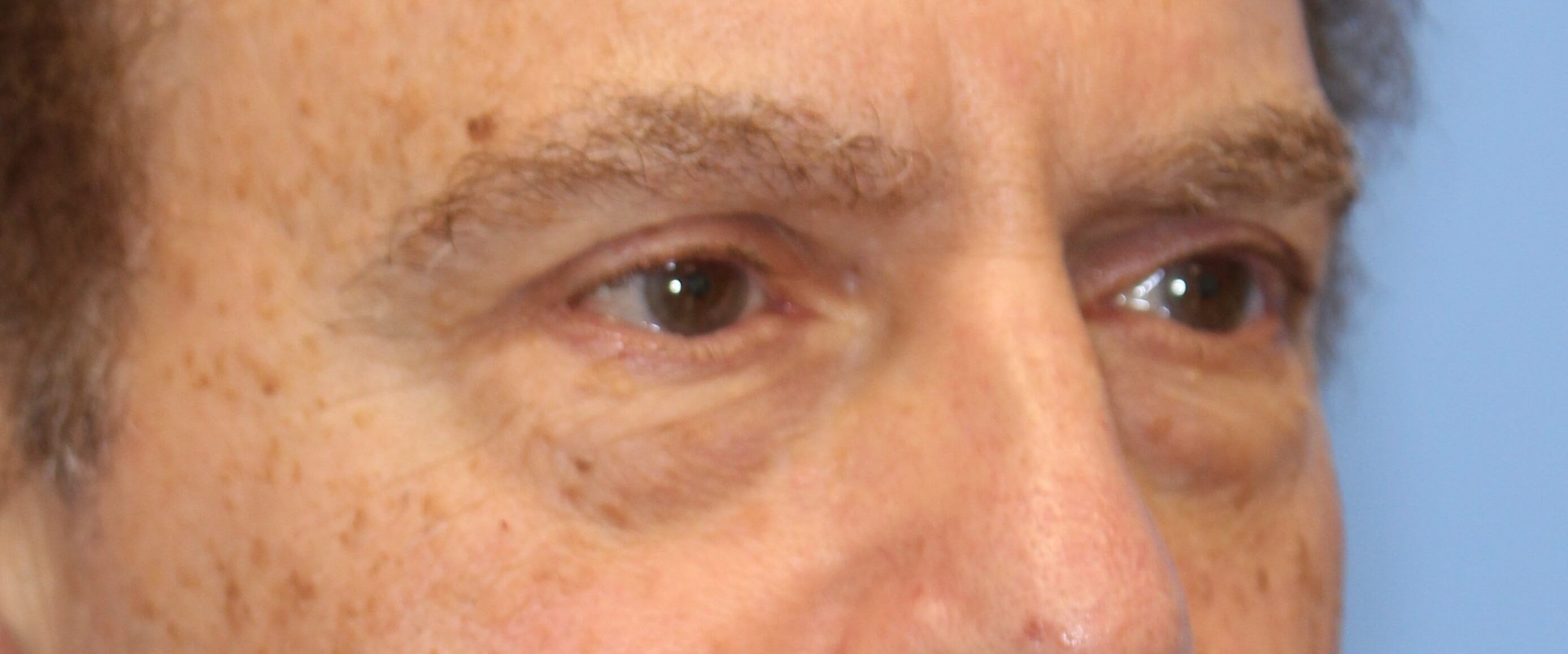 Lower Eyelid Lift Before