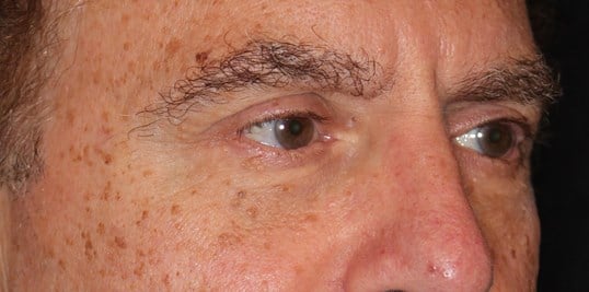 Lower Eyelid Lift After
