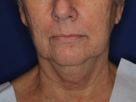 Double Chin Removal Before