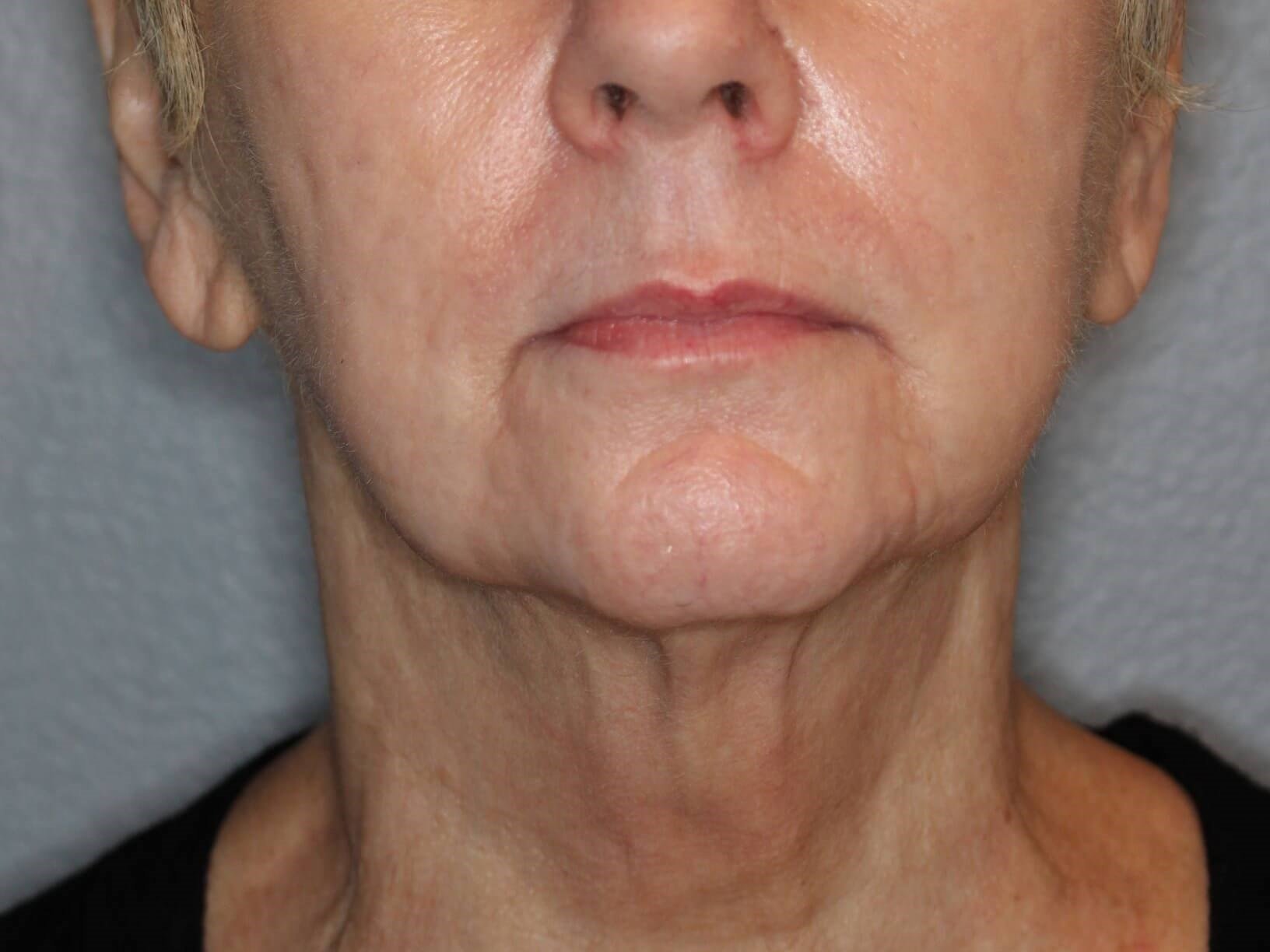 Double Chin Removal After