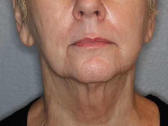 Double Chin Removal After