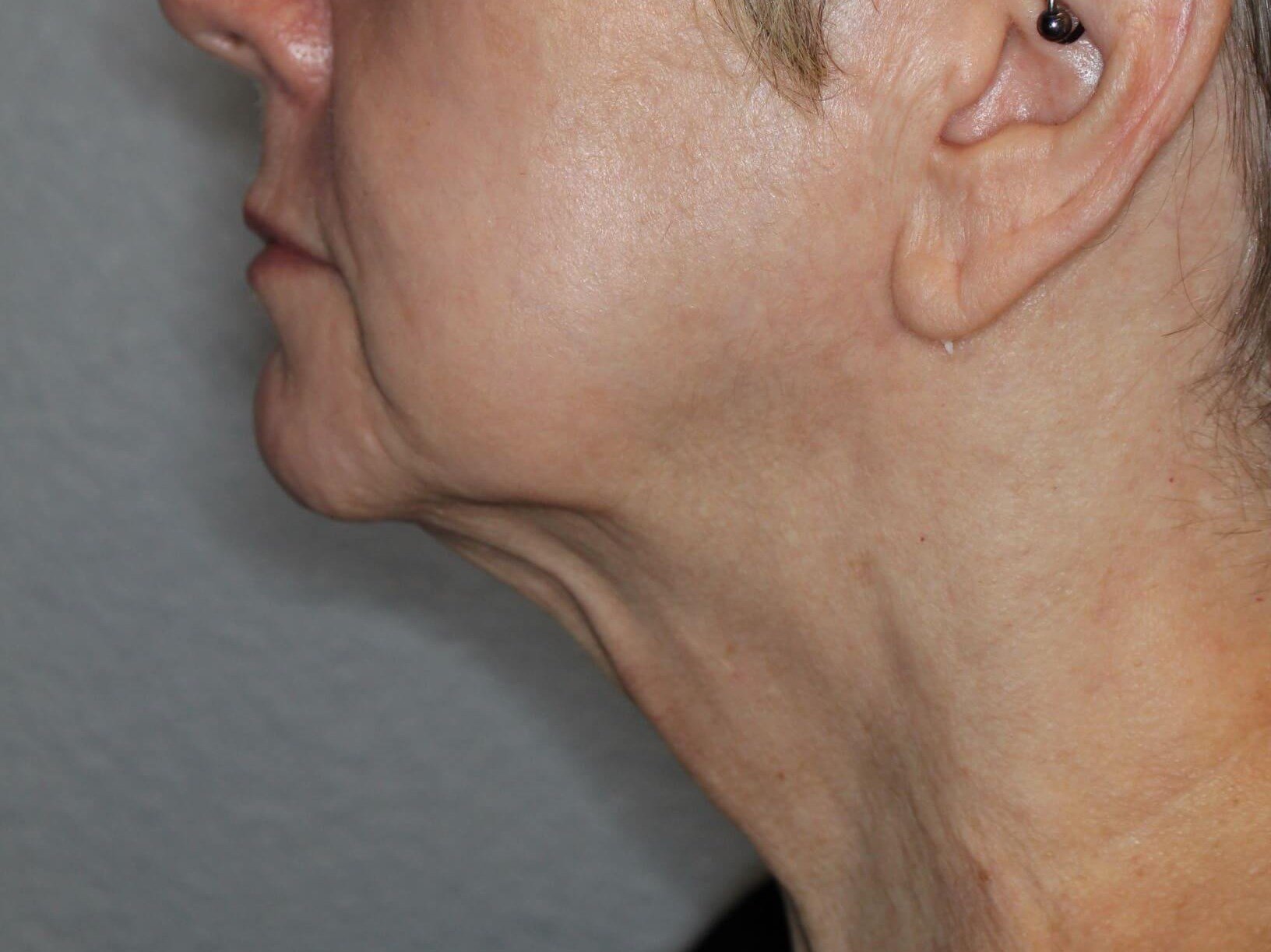 Double Chin Removal After