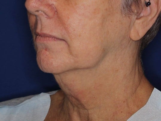 Double Chin Removal Before