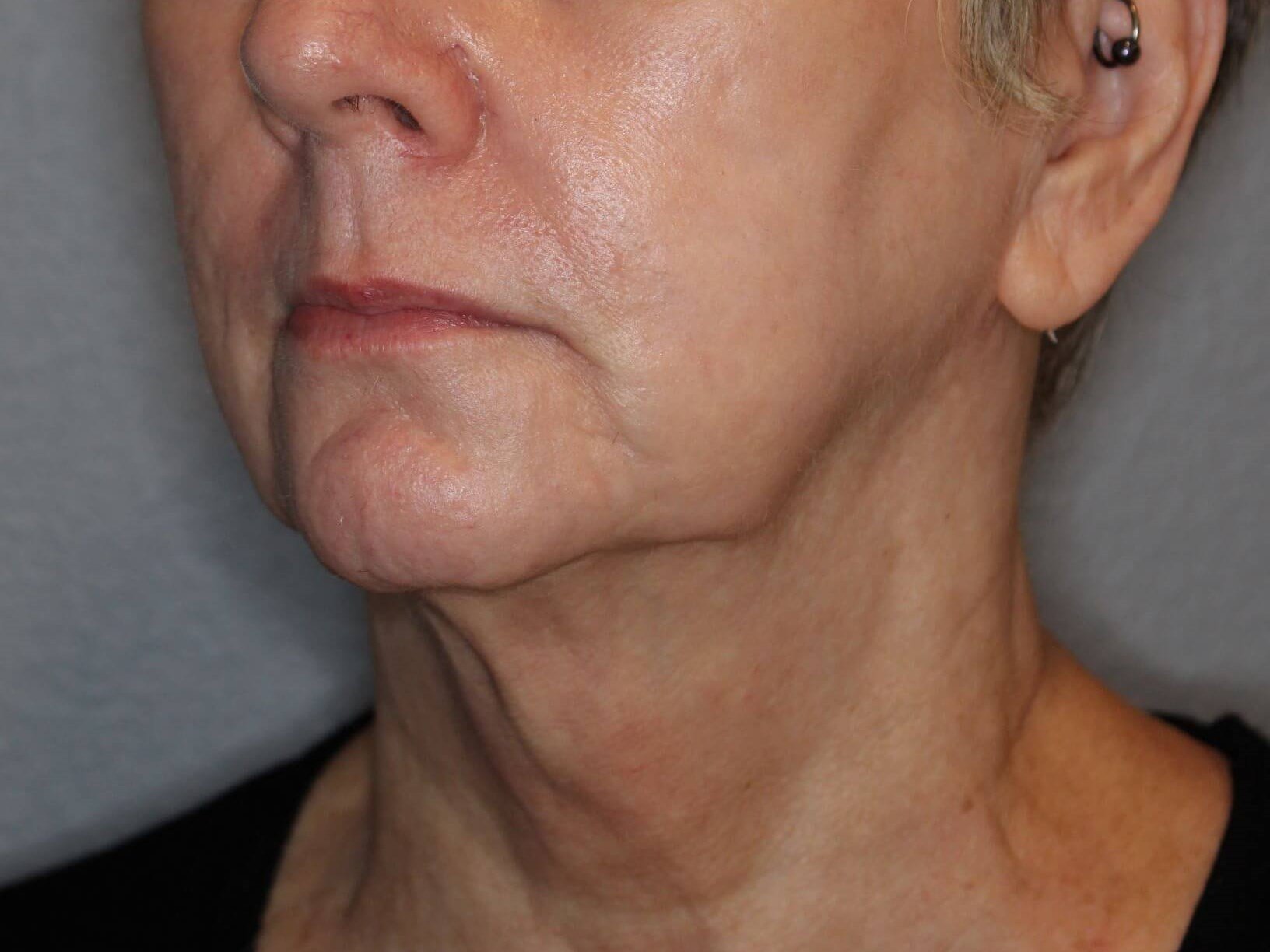 Double Chin Removal After