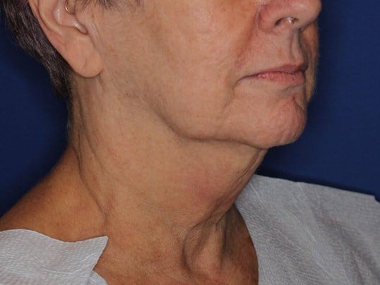 Double Chin Removal Before