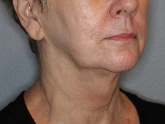 Double Chin Removal After