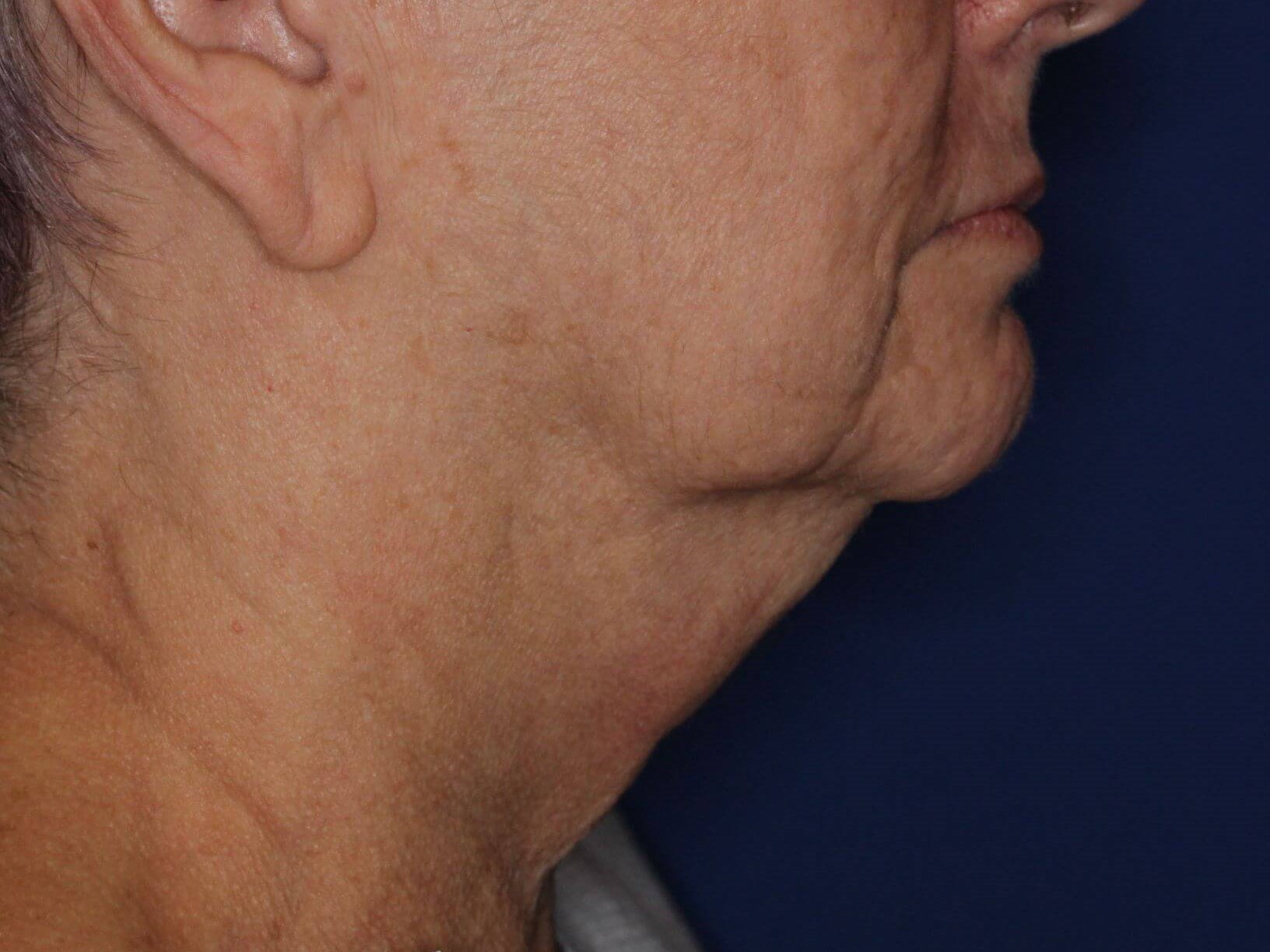 Double Chin Removal Before