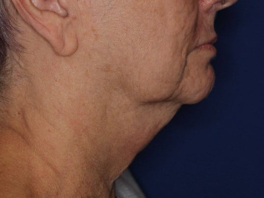 Double Chin Removal Before