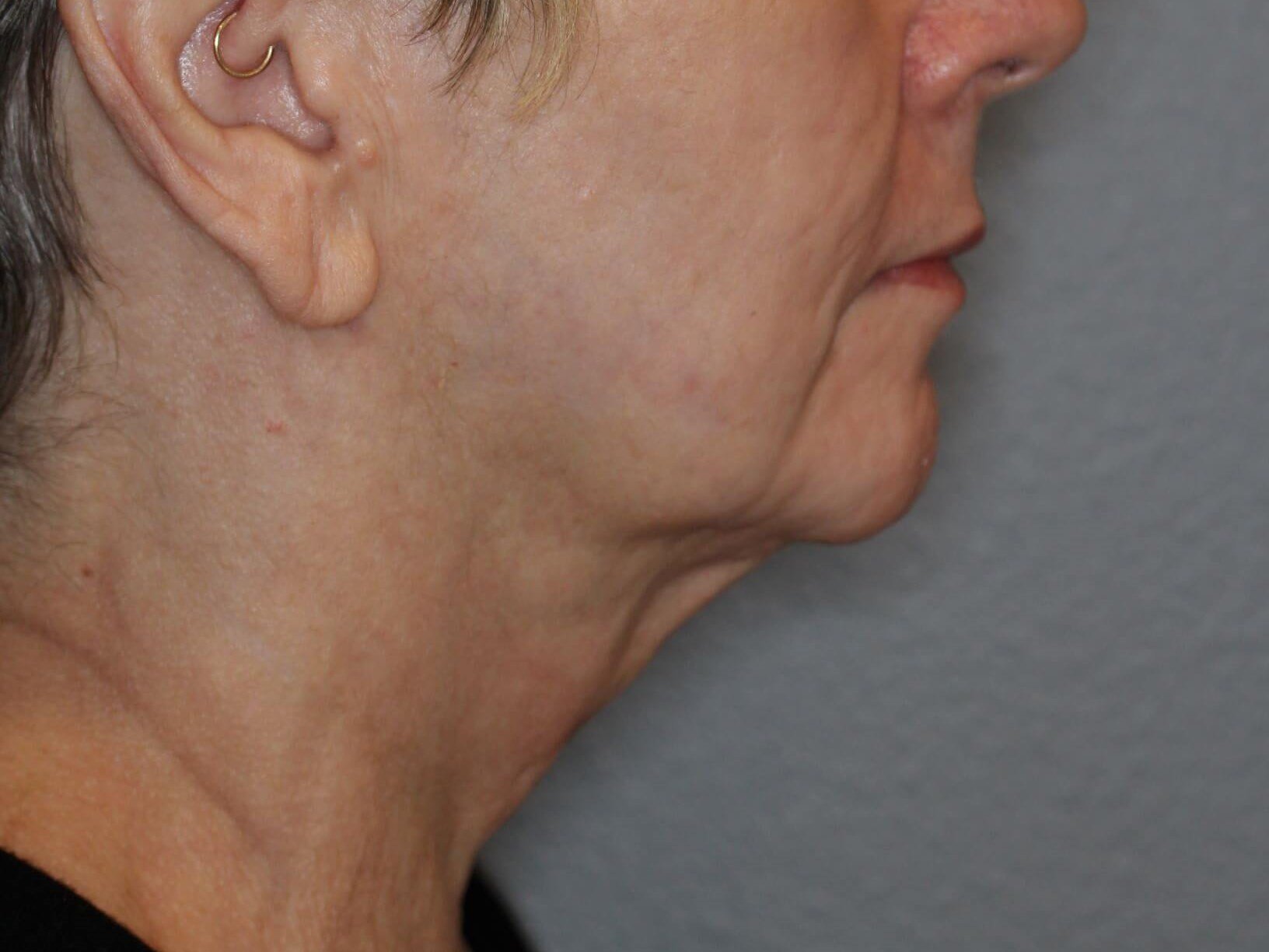 Double Chin Removal After