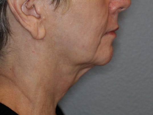 Double Chin Removal After
