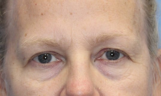 Brow Lift Before