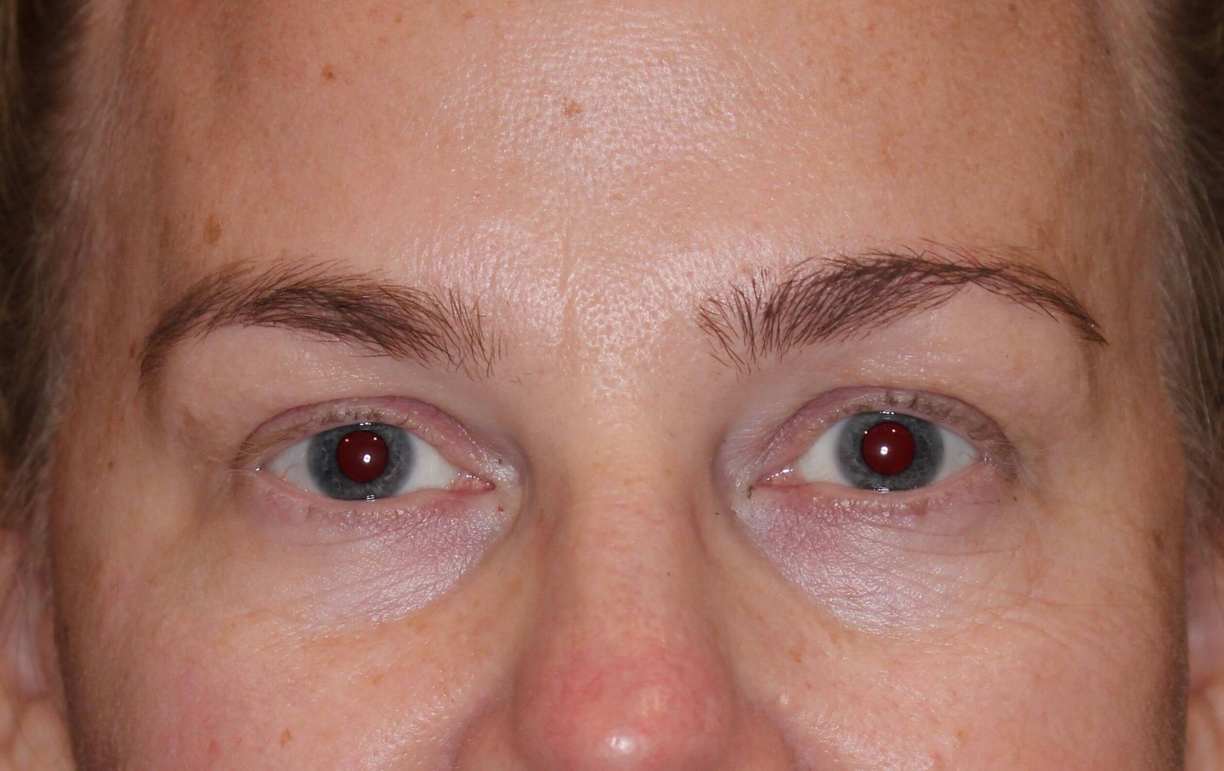 Brow Lift After