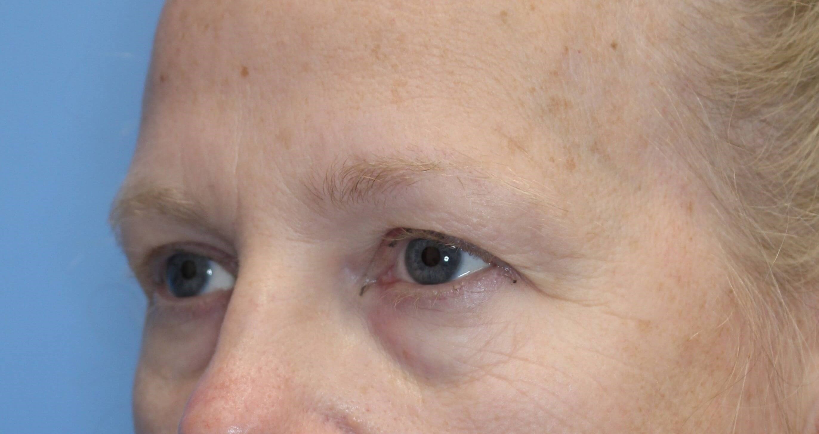 Brow Lift Before